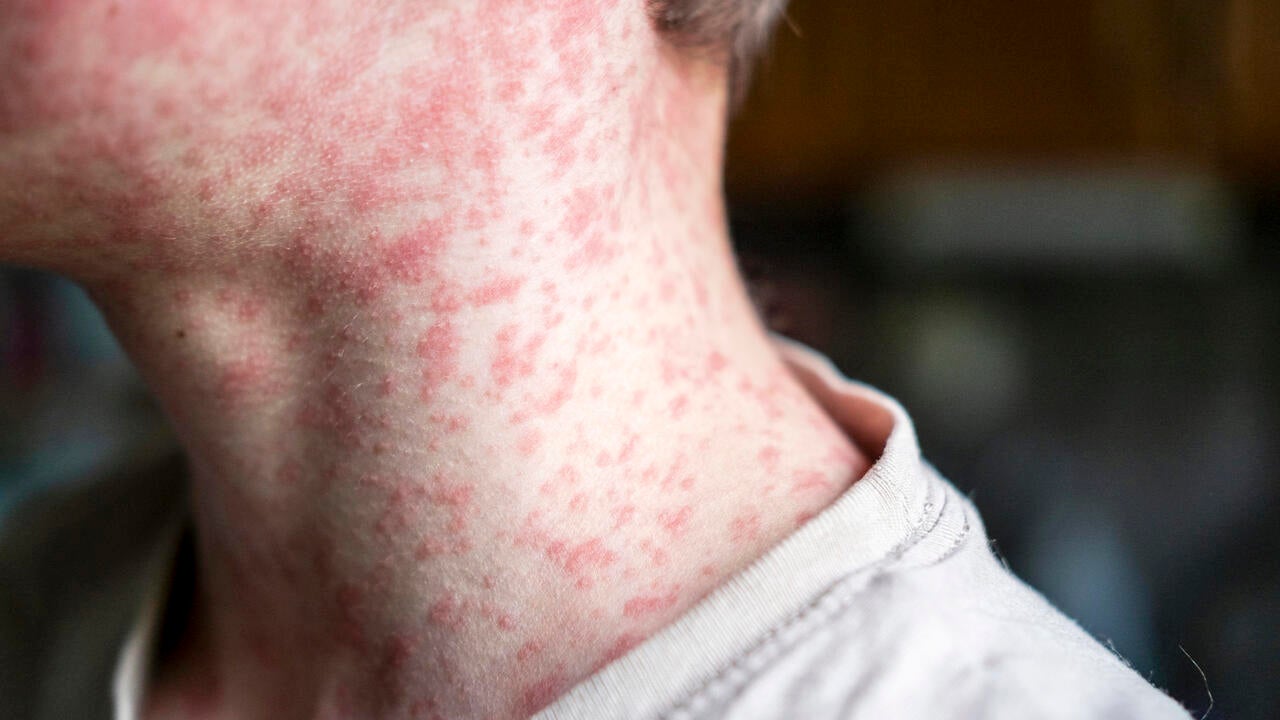 Person's neck and face covered in a measles rash